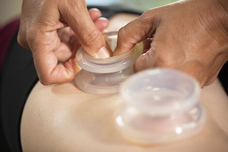 cupping technique being administered to a patient