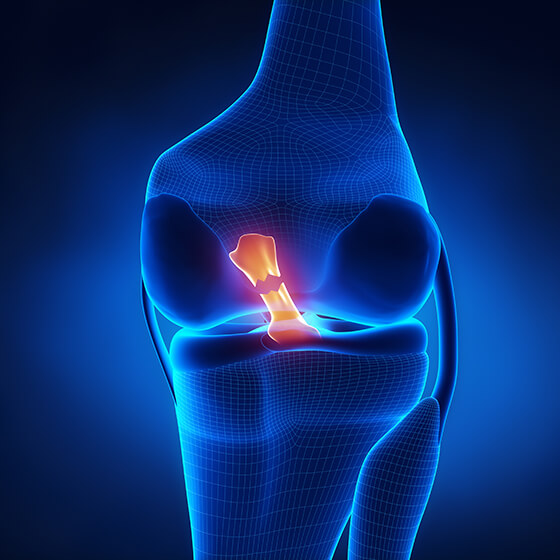 Illustration of an ACL tear.